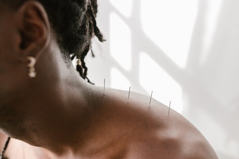 woman getting acupuncture