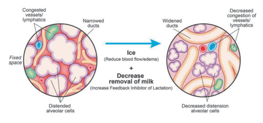 Baby Kingdom - Do you have breastfeeding related discomfort? Are you  looking for Mastitis Treatment and Mastitis Relief? Breastfeeding Ice and  Heat Packs are one of Mastitis Natural Remedies. Breast Heat Packs